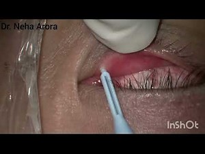 Punctal Plug Insertion | Dry Eyes | Eye7 preet vihar | Dr Neha Arora