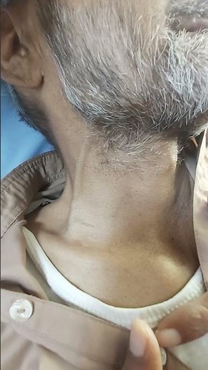 Distended neck veins | Acute heart failure #clinicalskills #doctor