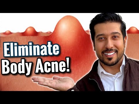 How to CLEAR Back Acne, Chest Acne, and Folliculitis | RID Body Acne!