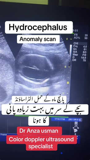 Understanding Hydrocephalus During Pregnancy