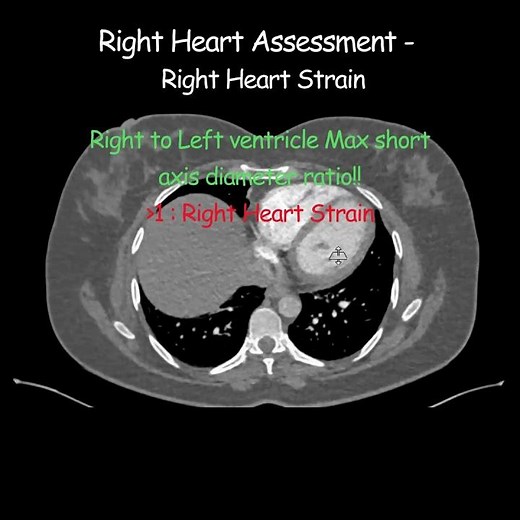 CT Pulmonary Angiogram - Right Heart Assessment - Right Heart Strain #radiology #radiologist