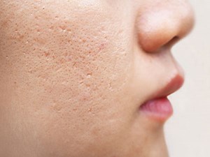 Dermatologist Acne Scar Treatment | Acne Scar Removal