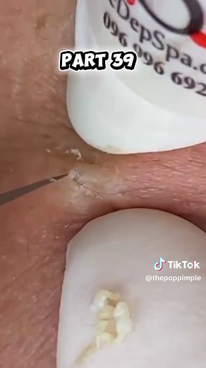 How to Remove Blackheads and Whiteheads Naturally