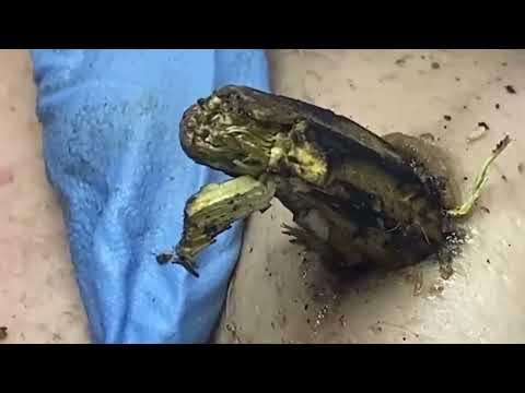 UNBELIEVABLE SKIN SECRETS – EXTREME SEBUM, DEEP PORES and SATISFYING EXTRACTIONS - PART 2