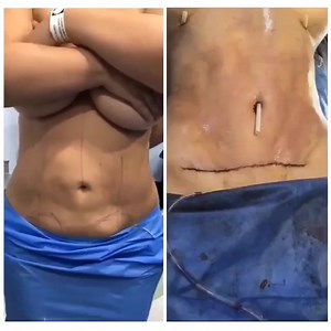 2.3K views | Abdominoplastia HD, más el poder de #Renuvion para eliminar la flacidez y obtener la cintura que siempre has querido. ¡Más fácil, imposible! ¡Agenda ahora tu cita de valoración!  55 5393 7834 ó 55 5393 8901 #BeverlyHills #CirugíaPlástica | Corpus & Rostrum | Facebook