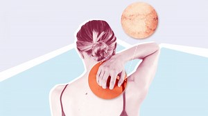 Everything You Need To Know About an Allergy Rash