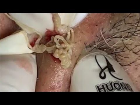 Deep blackhead Removal 2026, acne removal spa, big pimple 2026, #acne #pimple #cyst