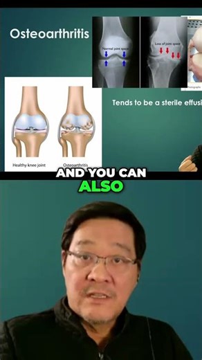 #24 Osteoarthritis Explained - X Ray Signs & Cadaver Visuals