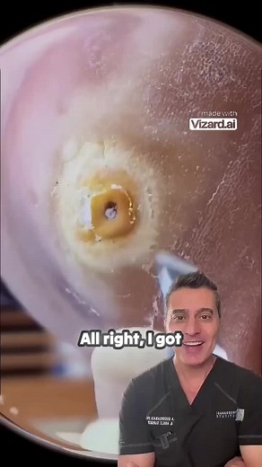 Incredible Plantar Wart Removal Process Revealed