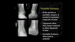 VIDEO: Ankle Replacement and Ankle Fusion: Surgery and Recovery