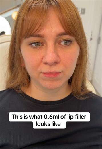 This is what 0.6ml of lip filler can look like. We worked mainly on the top lip to add volume and then added a small amount to the bottom of symmetry. #lips #plumplips #fillers #beauty #antiageing