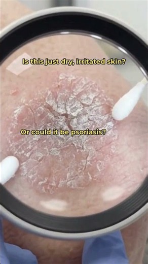 Sometimes what looks like “just dry skin” is actually something that needs a closer look. 👀