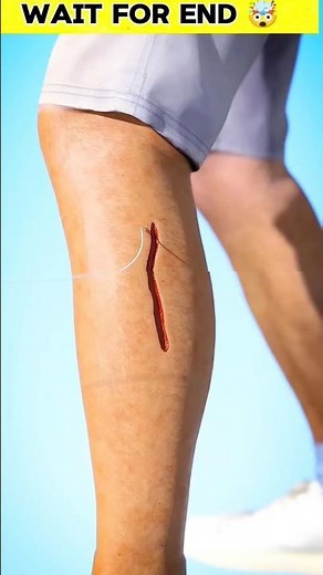 how stitches are applied ? 🤯 #shorts #short #viral