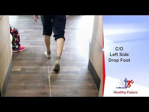 Foot Up Splint Video