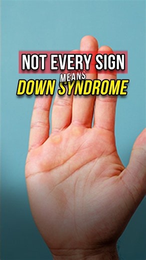 Not Every Sign Means Down Syndrome | A/Prof Stacey Tay
