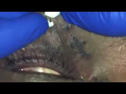 Satisfying Whitehead and Blackhead Removal on the Eyelids Acne Pimple Pop
