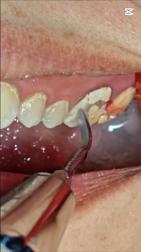What Professional Cleaning Actually Removes #DentalHealth #TartarRemoval #Satisfying