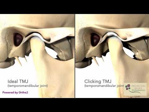 TMJ Clicking - Wellington Village Orthodontics