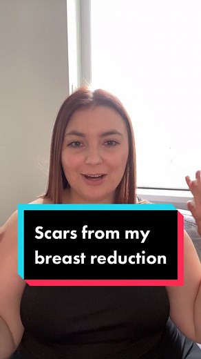 Breast reduction scars #fyp #breastreduction #breastreductionsurgery