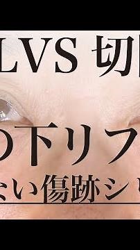 美容外科医にもばれにくい傷跡シリーズ：LVS切開式ハムラの3ヶ月後の傷跡