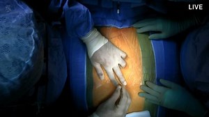 Bionic valve that can breathe life back into the heart