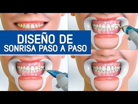 Diseño de sonrisa paso a paso / Odontoespecialistas