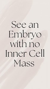 Such a pretty embryo, except… It doesn’t have an inner cell mass. The inner cell mass is a cluster of cells that should form once the embryo reaches the blastocyst stage of development. These cells ultimately develop into the baby if implantation occurs. Unfortunately, embryos without an inner cell mass are not recommended for transfer, even if they are otherwise ideal in appearance. This situation is different from a poor quality inner cell mass. #ivf #embryo #embryology #explainingivf #inferti