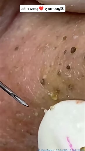 Effective Techniques for Pimple Extraction