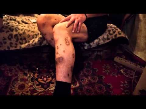 Krokodil, la droga zombi que pudre la piel