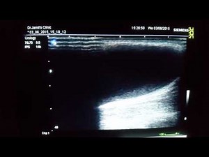 Baker's Cyst Ultrasound