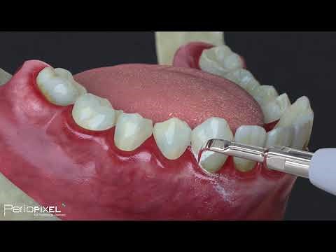 Tratamiento periodontal básico para pacientes (gingivitis y periodontitis) - Tráiler