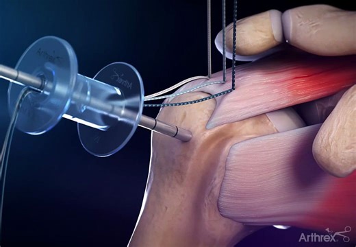 肩袖修复BoneSync™ Calcium Phosphate Cement Animation