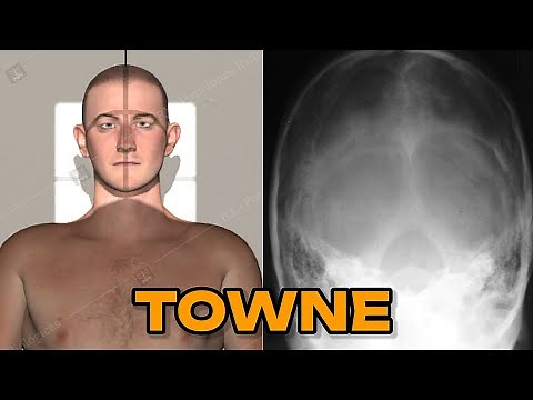SKULL X-RAY: TOWNE METHOD (POCKET MANUAL) #21