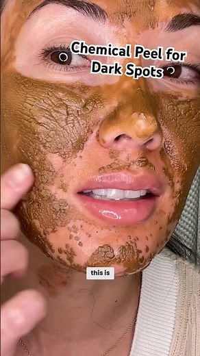 Chemical peel for dark spots, hyperpigmentation, & melasma! #skincare