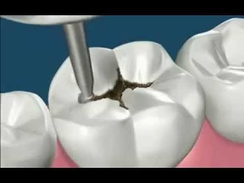 Quitar caries y reconstruir diente