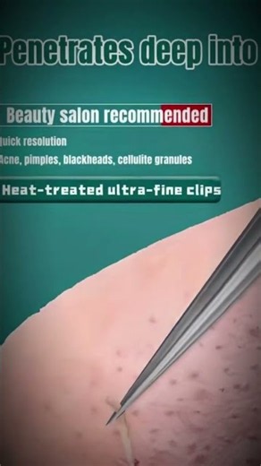 Blackhead Removal Tweezers Stainless Steel Tools
