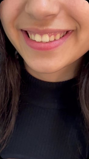 snap on smile on Instagram