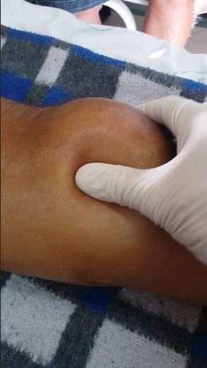 Knee effusion