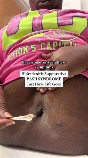 Have you ever seen symptoms like these with HS and PASH? Because for me, they don’t stay in one place. They show up in my belly button. My armpits. My legs. My inner thighs. My butt. Even my scalp sometimes. There is no “one area.” There is no predictable pattern. It’s inflammation that travels. Abscesses that form deep. Skin that breaks open when it wants to. And a level of pain that’s hard to put into words unless you’ve lived it. HS and PASH are no joke. The physical pain can be unbearable. T