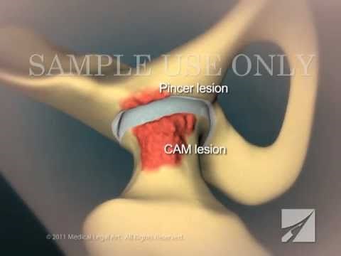 Femoroacetabular Impingement in the Hip