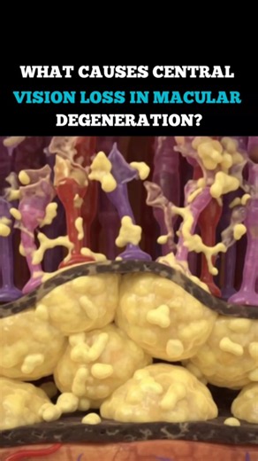 WHAT CAUSES CENTRAL VISION LOSS IN MACULAR DEGENERATION? #MacularDegeneration #Eye #Ophthalmology
