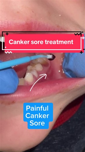 Canker Sore Treatment: Paint-On Liquid for Quick Pain Relief