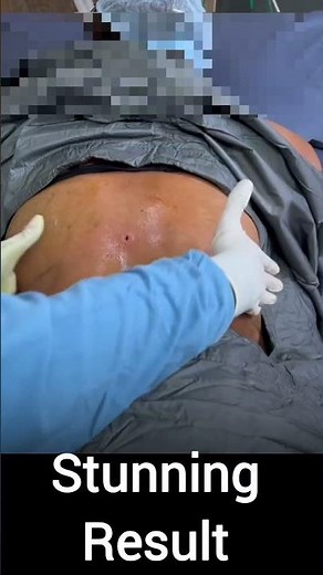 Belly Fat Removal with Liposuction | Amazing Before & After Results 🔥