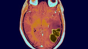 Dangerous brain abscesses spiked in US kids as COVID restrictions dropped