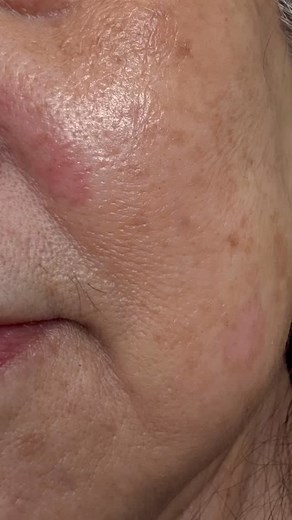 ✨ PIGMENT & FRECKLE REMOVAL – SEE THE DIFFERENCE IN JUST A FEW DAYS ✨...