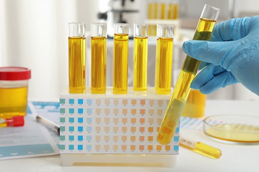 Aspect de l'urine : normal, couleur, trouble, foncée