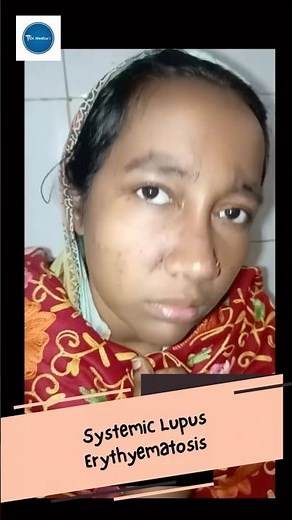 Dr Medica Clinical Cases || Systemic Lupus Erythematosis || Rheumatology ||