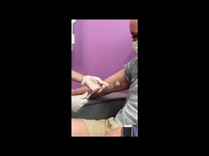 first access chemo arm port