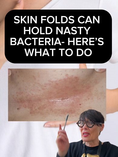 How to Keep Skin Folds Clean and Bacteria-Free