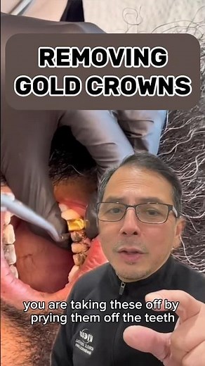 How to Remove GOLD Crowns WITHOUT Destroying It | In Office to Hands On Dental Training #shorts